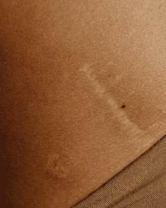 Woman showcasing a scar on her hip.