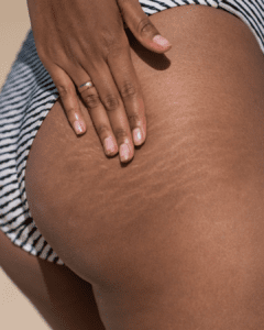 Woman in a bikini showcasing her stretch marks